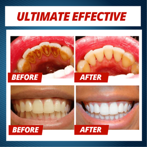 INTENSIVE STAIN REMOVAL WHITENING TOOTHPASTE - 50% OFF