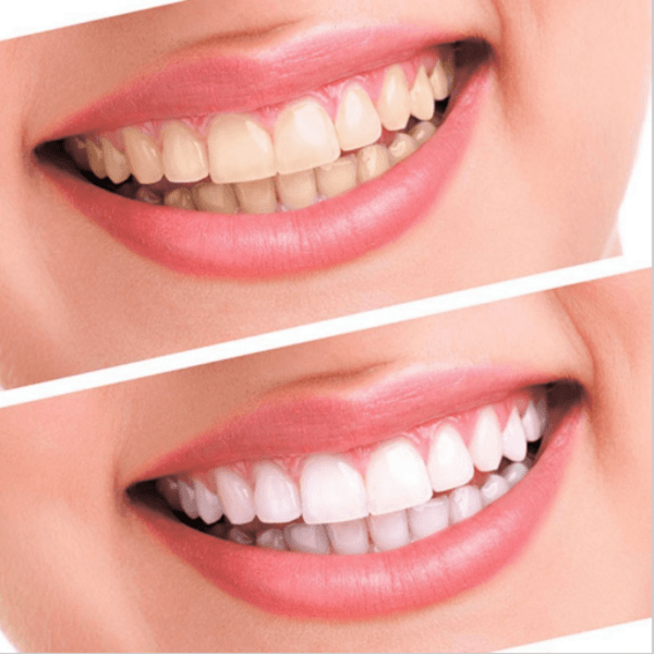 WHITE BRIGHT - NOW TEETH WHITENING CHANGES FOREVER